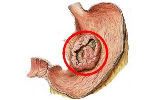 三个症状说明已有胃癌_三个症状说明已有胃癌会烧心吗